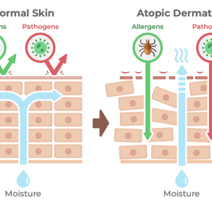 Epidermal barrier function disturbance in AD