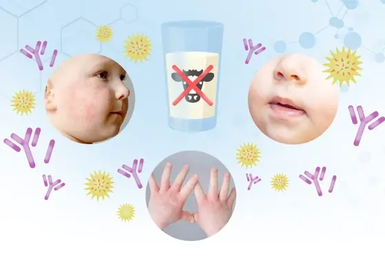 Unraveling Cow's Milk Protein Allergy (CMPA) in Infants and Young Children Unraveling Cow's Milk Protein Allergy (CMPA) in Infants and Young Children
