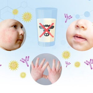 Unraveling Cow's Milk Protein Allergy (CMPA) in Infants and Young Children