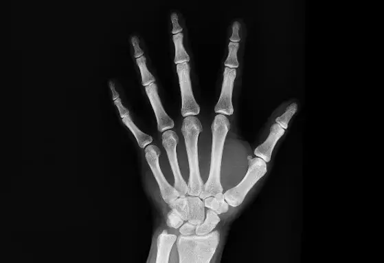 Vitamin D supplementation in adults does not prevent fractures, falls or improve bone mineral density (news) Vitamin D supplementation in adults does not prevent fractures, falls or improve bone mineral density (news)