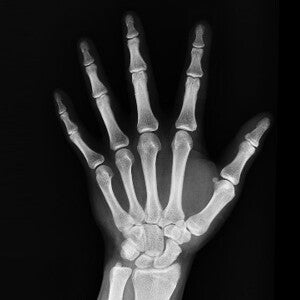 Vitamin D supplementation in adults does not prevent fractures, falls or improve bone mineral density (news)