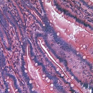 79th Nestlé Nutrition Institute Workshop: Inflammatory Bowel Disease (IBD) (events)